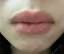 口唇縮小術 B-LINE CLINIC 池袋院 BEFORE サムネイル用