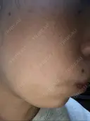 ピーリング（ニキビ・毛穴） 自由が丘クリニック BEFORE サムネイル用