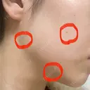 ほくろ・いぼ切除（肌） 赤坂メディカルMクリニック BEFORE サムネイル用