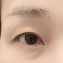眉下切開 湘南美容クリニック 秋葉原院 BEFORE サムネイル用
