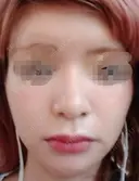 人中短縮 / 口角挙上 ドクターゴールドマンクリニック 東京高輪院 BEFORE サムネイル用