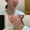 骨切り（あご） / 骨削り（エラ） / 骨削り（頬） id（アイディ）美容外科 BEFORE サムネイル用