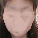 骨削り（頬） / 脂肪注入（肌） ボンディ美容整形外科（旧リオン整形外科） BEFORE サムネイル用