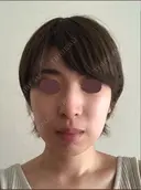 脂肪溶解注射（顔） 赤坂プレミアクリニック BEFORE サムネイル用
