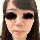 隆鼻術 / 鼻尖形成（切開） / 鼻中隔延長（切開） / 小鼻縮小（切開） / 鼻尖縮小 FROM B整形外科 (旧バウム整形外科) BEFORE サムネイル用