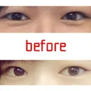 二重埋没 湘南美容クリニック 大宮院 BEFORE サムネイル用