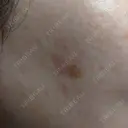 YAGレーザー 新宿美容外科クリニック 横浜院 BEFORE サムネイル用