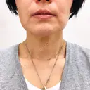バッカルファット除去 TCB東京中央美容外科 堺院 BEFORE サムネイル用