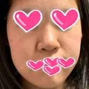 隆鼻術 / 鼻尖形成（切開） / 鼻中隔延長（切開） / 小鼻縮小（切開） / 眉間プロテーゼ ラミチェ美容整形外科 BEFORE サムネイル用