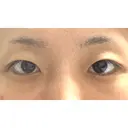 二重埋没 湘南美容クリニック 松山院 BEFORE サムネイル用