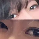 二重切開 / 上まぶたたるみ取り 湘南美容クリニック 広島院 BEFORE サムネイル用