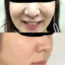 メーラーファット除去 WOM CLINIC GINZA （ワム クリニック ギンザ） BEFORE サムネイル用