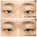 二重切開 / 上まぶたたるみ取り 広島プルミエクリニック BEFORE サムネイル用