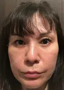エレクトロポレーション / ピコレーザートーニング（美白・肝斑） / フラクショナルレーザー（毛穴・ニキビ跡） 麗ビューティー皮フ科クリニック BEFORE サムネイル用