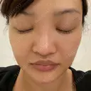 骨削り（エラ） / 骨削り（頬） / その他（輪郭） バノバギ整形外科 BEFORE サムネイル用