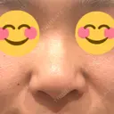 隆鼻術 たにまちクリニック BEFORE サムネイル用