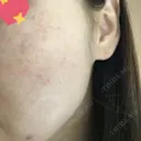 美肌レーザー / シミ取りレーザー / ピコレーザートーニング（美白・肝斑） 湘南美容クリニック 秋葉原院 BEFORE サムネイル用