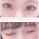 二重埋没 湘南美容クリニック 赤坂見附院 BEFORE サムネイル用