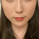 ハイフ（顔） Zetith Beauty Clinic 銀座院 BEFORE サムネイル用