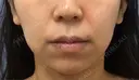 バッカルファット除去 / 脂肪吸引（顔） 湘南美容クリニック 那覇院 BEFORE サムネイル用