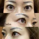 眉下切開 湘南美容クリニック 秋葉原院 BEFORE サムネイル用