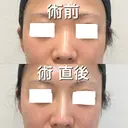ヒアルロン酸注入（鼻） BIANCA銀座 BEFORE サムネイル用