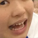 セラミック パール歯科医院 BEFORE サムネイル用