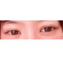 二重埋没 盛岡タウン形成外科クリニック BEFORE サムネイル用