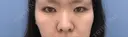 目頭切開 / 鼻尖形成（切開） / 鼻中隔延長（切開） 湘南美容クリニック 金沢院 BEFORE サムネイル用