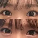 二重埋没 湘南美容クリニック 宇都宮院 BEFORE サムネイル用
