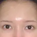 二重埋没 / 目元修正 BIANCA銀座 BEFORE サムネイル用