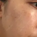 シミ取りレーザー / YAGレーザー 仁愛クリニック BEFORE サムネイル用