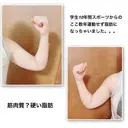 脂肪吸引（二の腕） Mods Clinic（モッズクリニック） 東京院 BEFORE サムネイル用