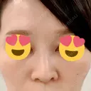 スレッドノーズ 品川スキンクリニック銀座院 BEFORE サムネイル用