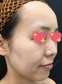 糸リフト / ボトックス（あご） / 肌ヒアルロン酸注入（たるみ・シワ改善） / ボトックス（口角） 湘南美容クリニック 秋葉原院 BEFORE サムネイル用