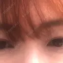 クマ治療 / ヒアルロン酸注入（涙袋） プラストクリニック BEFORE サムネイル用