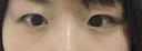 二重切開 / 目頭切開 / 眼瞼下垂（切開） / 目尻切開 湘南美容クリニック 大阪堺東院 BEFORE サムネイル用