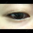 二重埋没 / 脂肪吸引（顔） 表参道スキンクリニック 表参道院 BEFORE サムネイル用