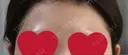 額を丸く / 脂肪注入（額） / ヒアルロン酸注入（額） / その他（輪郭） エートップ美容整形外科 BEFORE サムネイル用