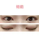 二重切開 水の森美容クリニック 東京新宿院 BEFORE サムネイル用