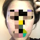 ピーリング（ニキビ・毛穴） 自由が丘クリニック BEFORE サムネイル用