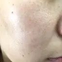 ほくろ・いぼ切除（肌） / 美肌レーザー / シミ取りレーザー / 美白レーザー REYOUNGクリニック BEFORE サムネイル用