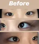 二重埋没 TCB東京中央美容外科 仙台駅前院 BEFORE サムネイル用