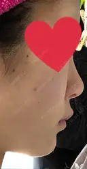 レディエッセ注入（鼻） フィラークリニック 新宿院 BEFORE サムネイル用