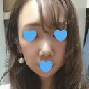 鼻尖形成（切開） / 軟骨移植 / 眉間プロテーゼ / 鼻尖縮小 湘南美容クリニック 柏院 BEFORE サムネイル用