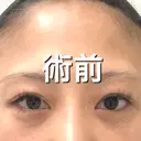 二重切開 BIANCA銀座 BEFORE サムネイル用