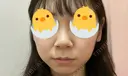 鼻尖形成（切開） / 小鼻縮小（切開） / ヒアルロン酸注入（あご） / ボトックス（エラ・小顔） / ヒアルロン酸注入（唇） / 毛穴洗浄（ハイドラフェイシャルなど） / その他（鼻） TCB東京中央美容外科 横浜院 BEFORE サムネイル用