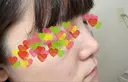 隆鼻術 / 鼻尖形成（切開） / 小鼻縮小（切開） / 軟骨移植 / 鼻翼基部形成（貴族手術） グローバルビューティークリニック 大阪院 BEFORE サムネイル用
