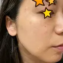 ピーリング（ニキビ・毛穴） / 美肌レーザー / フラクショナルレーザー（毛穴・ニキビ跡） PICO BEAUTY CLINIC BEFORE サムネイル用