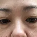 下まぶたの脂肪取り 水戸中央美容形成クリニック BEFORE サムネイル用